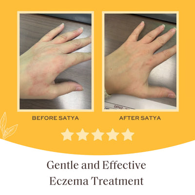 Satya Organic Eczema Relief