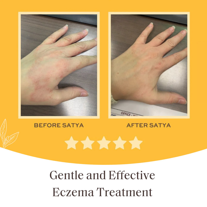 Satya Organic Eczema Relief